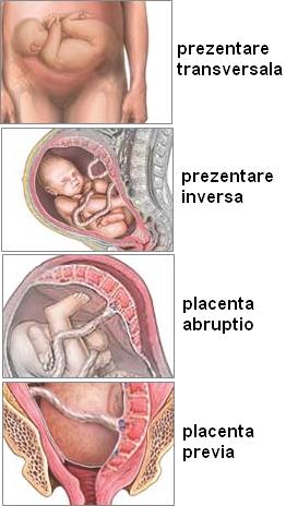 indicatii pentru cezariana